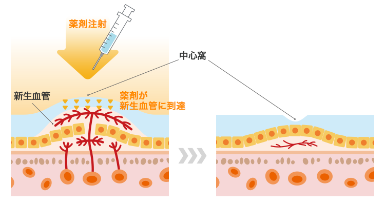 VEGF阻害薬(眼内への注射)